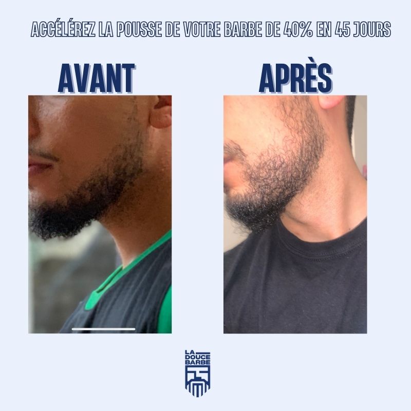 la-douce-barbe-dermaroller-barbe-rouleau-pousse-0-5-mm image 4