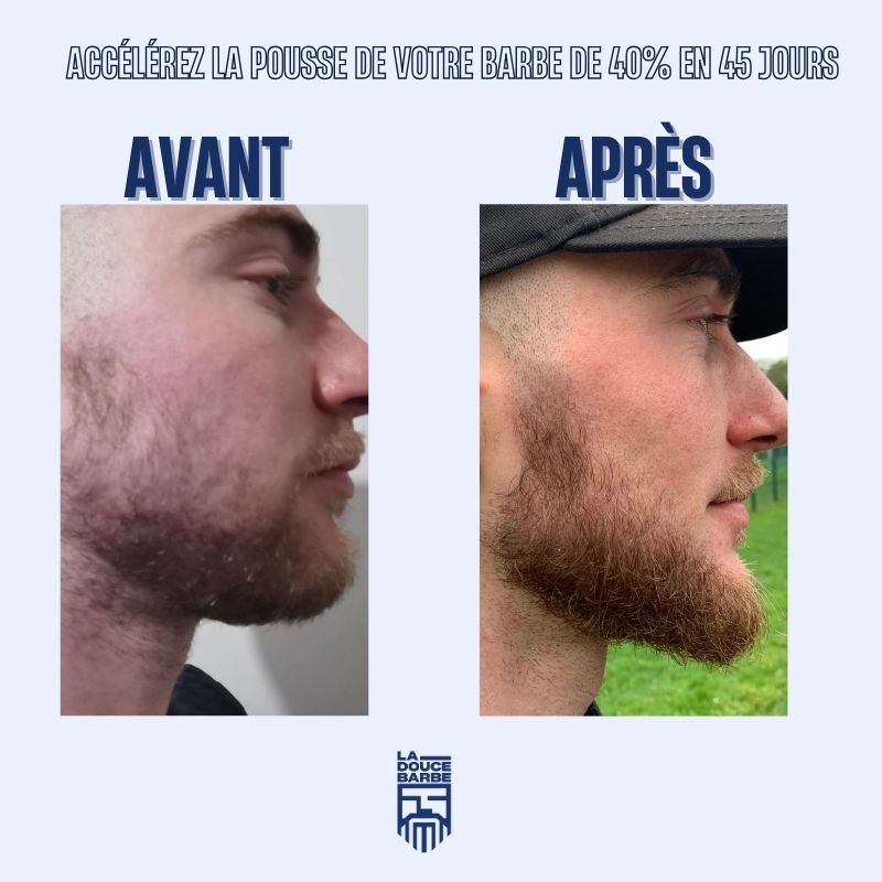 la-douce-barbe-dermaroller-barbe-rouleau-pousse-0-5-mm image 5