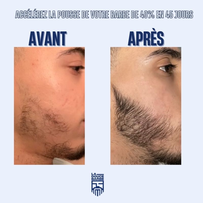 la-douce-barbe-dermaroller-barbe-rouleau-pousse-0-5-mm image 7